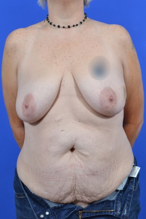 buttock tissue breast reconstruction