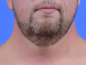 neck liposuction for men
