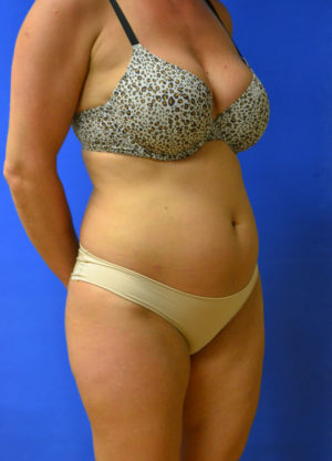 Liposuction Results St. Louis