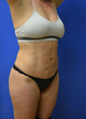 Liposuction Results St. Louis