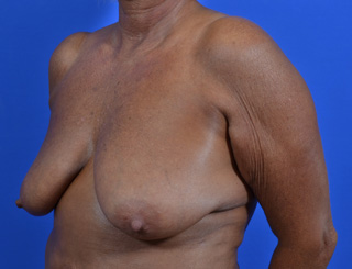 Breast Implants with Lift