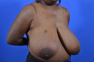 Breast Reduction