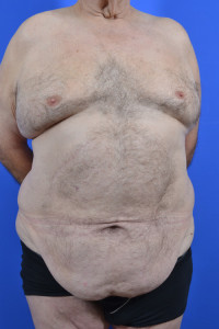 Panniculectomy Result St. Louis