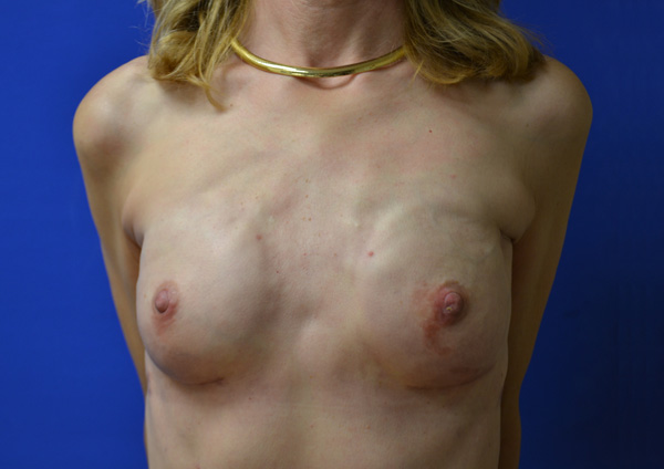 Reconstructive Revision Breast Surgery