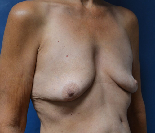 Breast Implants with Lift