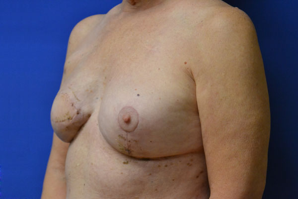 Reconstructive Revision Breast Surgery