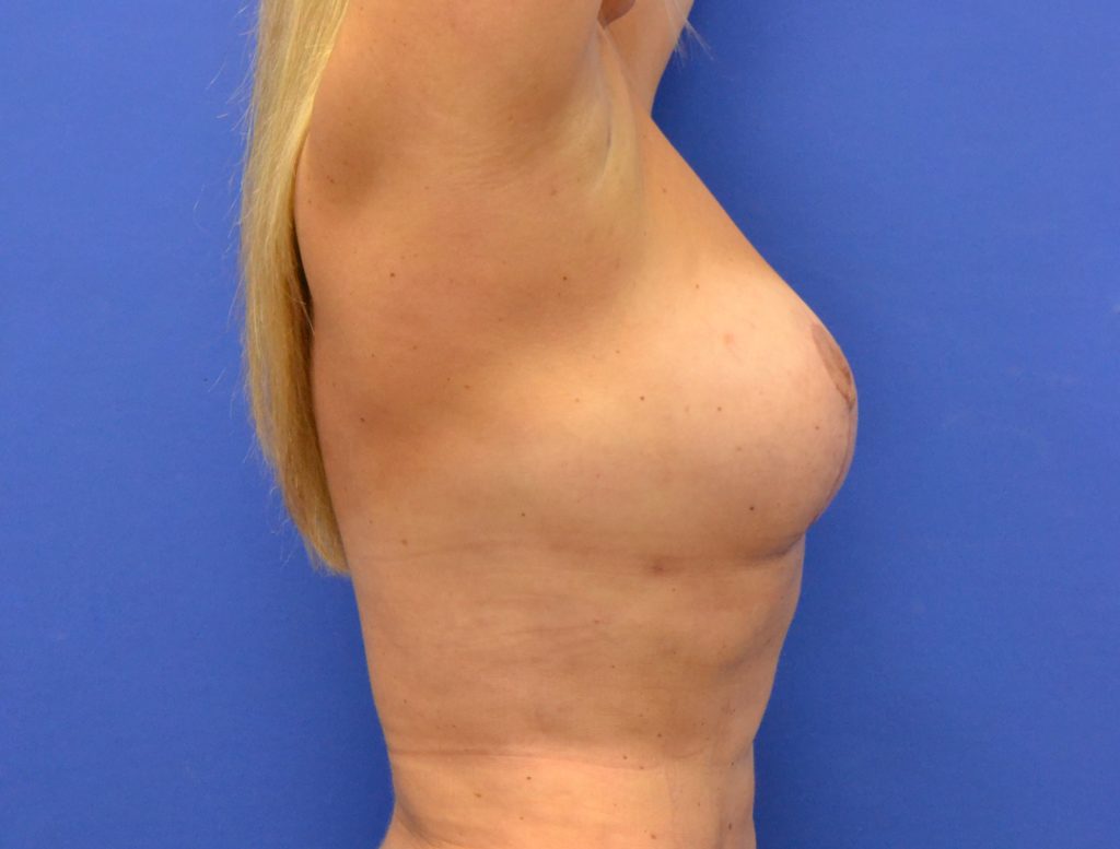 Breast Procedures