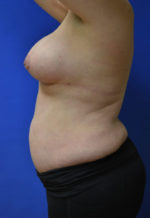 Breast Implants