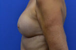 Revision Breast Surgery