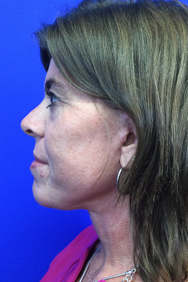 Face and Neck Lift