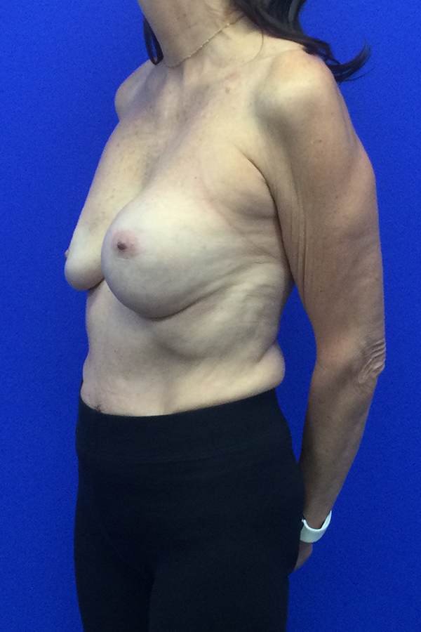 Revision Breast Surgery
