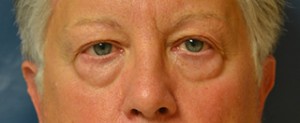 eyelid surgery for men