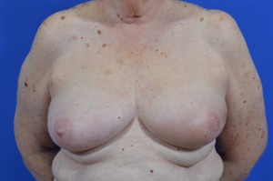 breast latissimus flap 1-stage