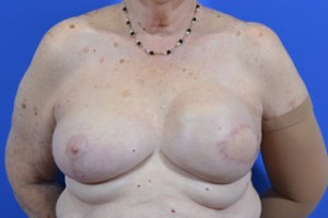 breast reduction for symmetry
