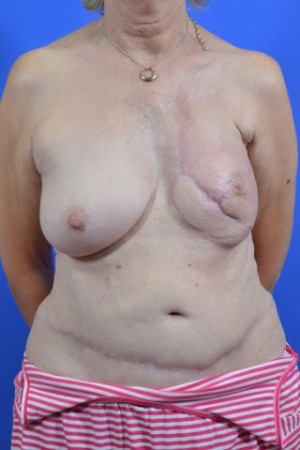 thigh tissue breast reconstruction