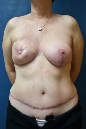 breast mastopexy for symmetry