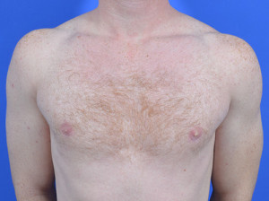 removal of breast tissue