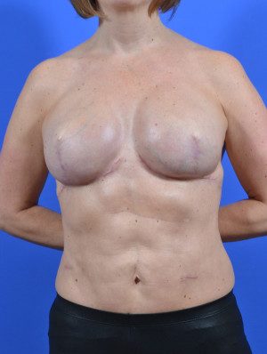 breast reconstruction cancer