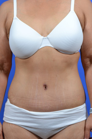 Lower Body Lift Surgery Results St. Louis