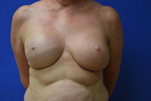 breast recontruction