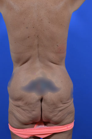 brazilian butt lift - body contouring