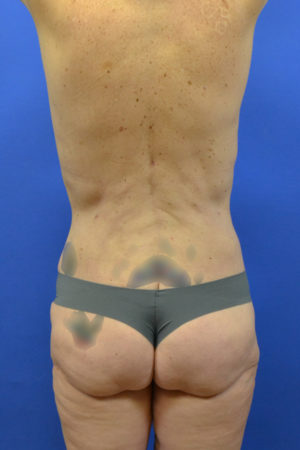 brazilian butt lift - butt augmentation