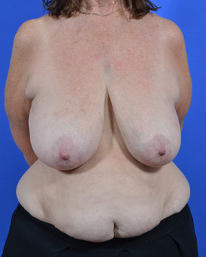 abdominal tissue TRAM flap breast reconstruction