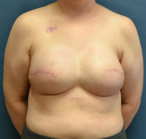 latissimus flap with implant reconstruction
