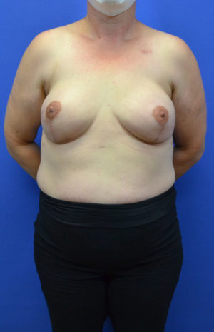 breast implants with acellular dermis