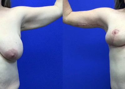 Arm Lift before and after photos by Cabbabe Plastic Surgery in Saint Louis, MO