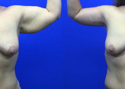 Arm Lift before and after photos by Cabbabe Plastic Surgery in Saint Louis, MO