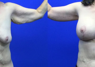 Arm Lift before and after photos by Cabbabe Plastic Surgery in Saint Louis, MO