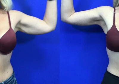 Arm Lift before and after photos by Cabbabe Plastic Surgery in Saint Louis, MO