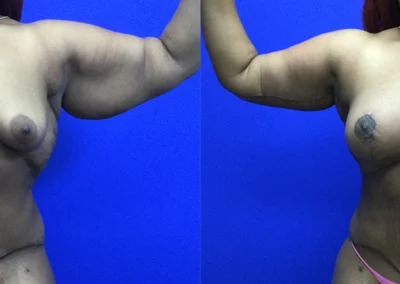 Arm Lift before and after photos by Cabbabe Plastic Surgery in Saint Louis, MO