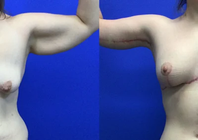 Arm Lift before and after photos by Cabbabe Plastic Surgery in Saint Louis, MO