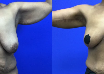 Arm Lift before and after photos by Cabbabe Plastic Surgery in Saint Louis, MO