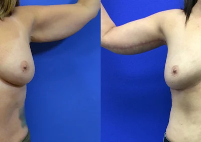 Arm Lift before and after photos by Cabbabe Plastic Surgery in Saint Louis, MO