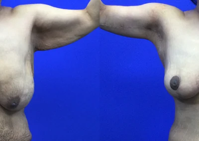 Arm Lift before and after photos by Cabbabe Plastic Surgery in Saint Louis, MO
