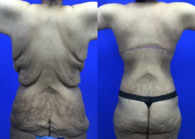 Upper Body Lift before and after photos by Cabbabe Plastic Surgery in Saint Louis, MO
