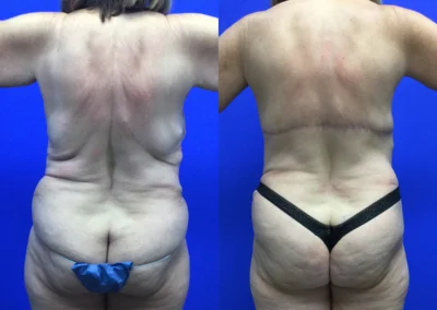 Upper Body Lift before and after photos by Cabbabe Plastic Surgery in Saint Louis, MO