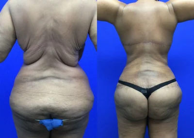 Upper Body Lift before and after photos by Cabbabe Plastic Surgery in Saint Louis, MO