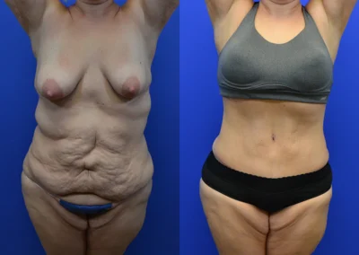 Revision Body Contouring before and after photos by Cabbabe Plastic Surgery in Saint Louis, MO