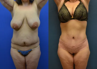 Revision Body Contouring before and after photos by Cabbabe Plastic Surgery in Saint Louis, MO