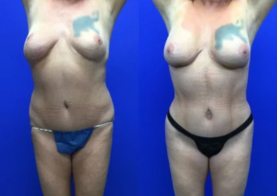Revision Body Contouring before and after photos by Cabbabe Plastic Surgery in Saint Louis, MO