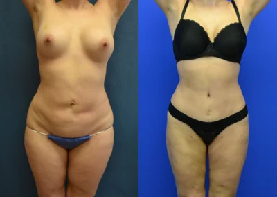Revision Body Contouring before and after photos by Cabbabe Plastic Surgery in Saint Louis, MO