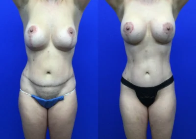 Revision Body Contouring before and after photos by Cabbabe Plastic Surgery in Saint Louis, MO
