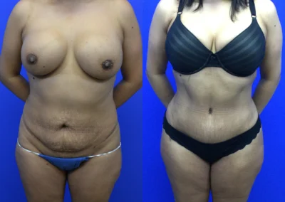 Revision Body Contouring before and after photos by Cabbabe Plastic Surgery in Saint Louis, MO