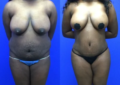 Plus Size Body Contouring before and after photos by Cabbabe Plastic Surgery in Saint Louis, MO
