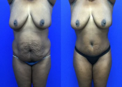 Plus Size Body Contouring before and after photos by Cabbabe Plastic Surgery in Saint Louis, MO