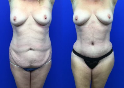 Plus Size Body Contouring before and after photos by Cabbabe Plastic Surgery in Saint Louis, MO